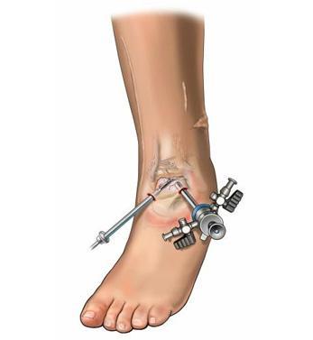 Arthroscopic (Closed) Ankle Surgery
