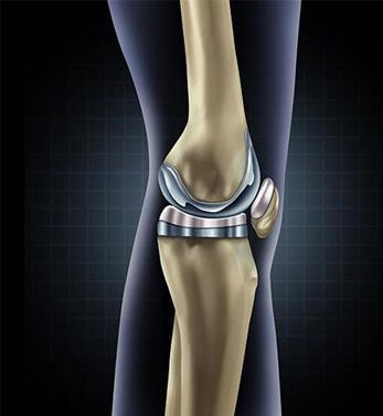 Knee Implant Surgery