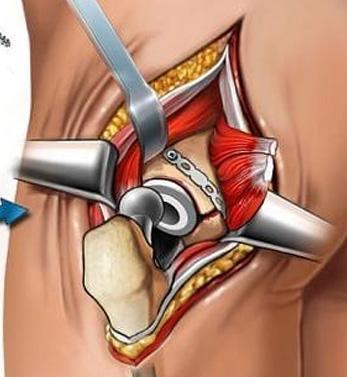 Hip Implant Surgery