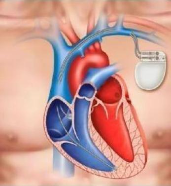 Kalp Pili Yerleştirme