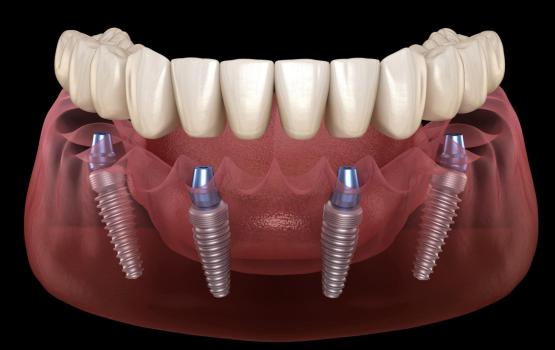 All On 4 Implant Treatment