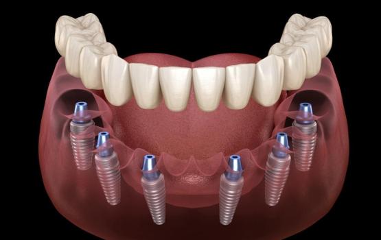 All On 6 Implant Treatment