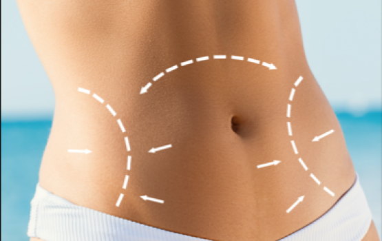Karın Germe & 2 Bölge Liposuction