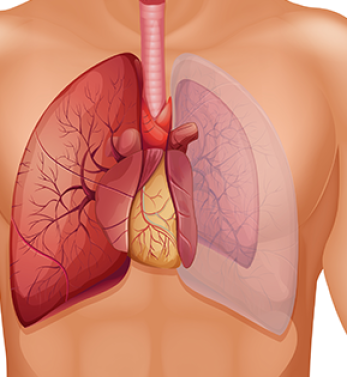 Akciğer Sönmesi (Pnömotoraks)