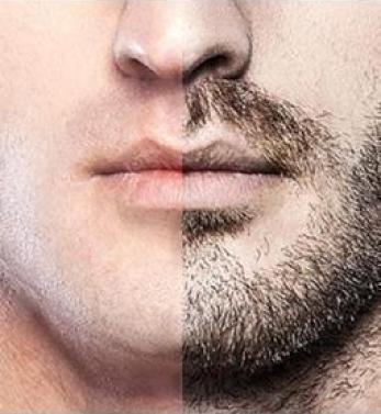 Beard & Mustet Transplantation ( FUE or DHI )