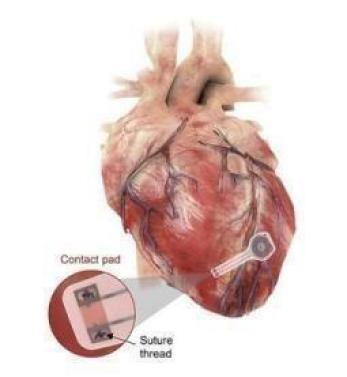 Temporary Pacemaker