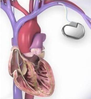 Implantable Cardioverter Defibrillator (LCD)