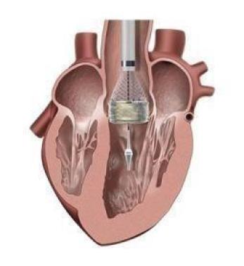 Non-Surgical Heart Valve Replacement